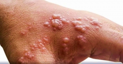 आंध्र प्रदेश में संदिग्ध मंकीपॉक्स रोगी का टेस्ट आया निगेटिव